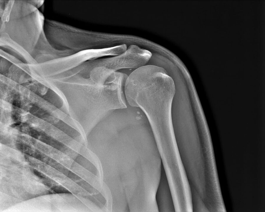 Рентгенова снимка на артроза на раменната става от 2-ра степен на тежест