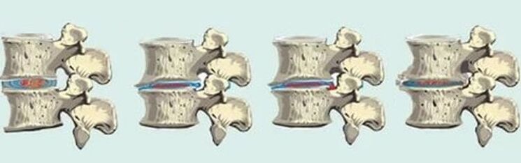 лезия на гръбначния стълб в случай на гръдна остеохондроза