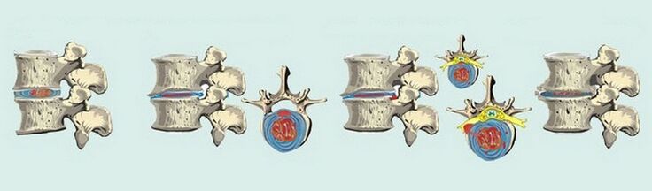 Етапи на образуване на остеохондроза на гръбначния стълб