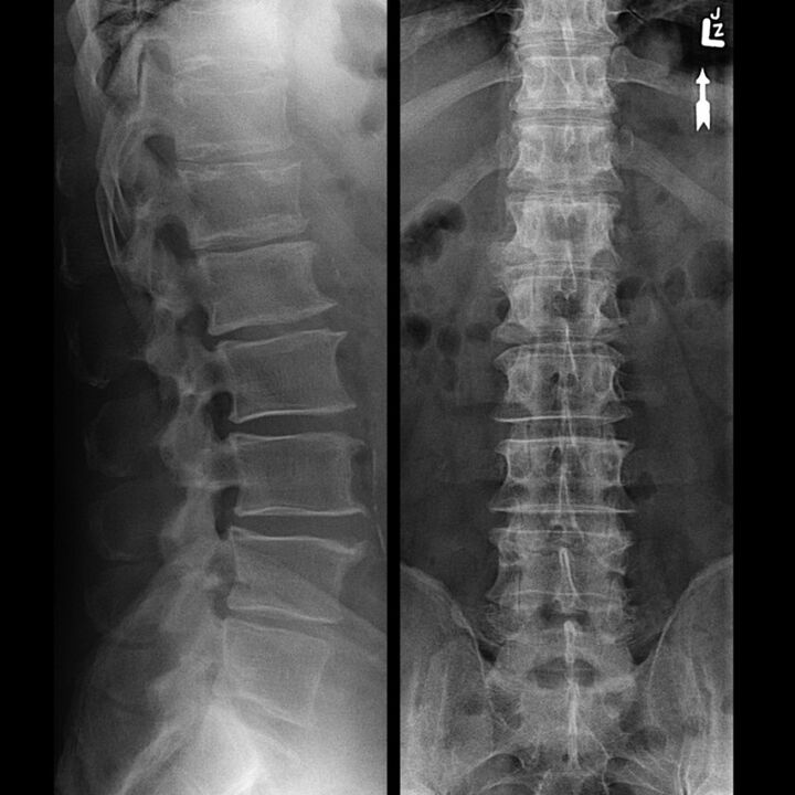 Рентгенова снимка на гръдната област, която показва намаляване на пролуката между прешлените по гръбначния стълб отдолу нагоре