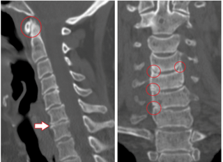 КТ показва увредени прешлени и дискове с разнородна височина поради гръдна остеохондроза