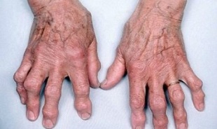 как да разграничим артрита на пръстите от артрозата