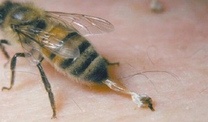лечение на тазобедрена артроза от пчели